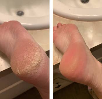 Reviewer showing before and after results of using O'Keefe's Healthy Feet foot cream