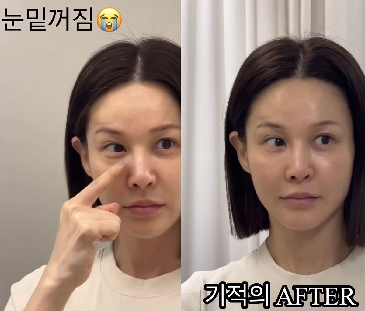 아이비도 고민한 '눈 밑 꺼짐'… 지방 재배치 전후, 어떻게 다른가?