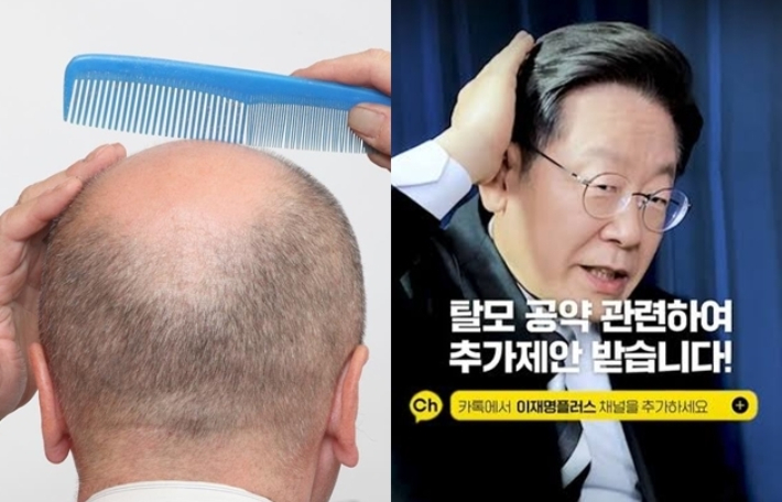 탈모 치료 건강보험 지원 논란, 생존권 보장인가 재정 낭비인가