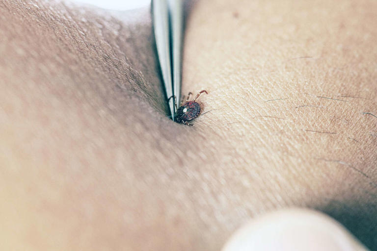 Ticks — a hidden summer danger — can be as near as your skin