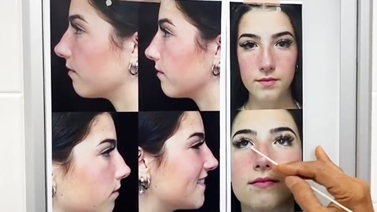 Plastic surgeon reacts to Charli D’Amelio’s nose surgery