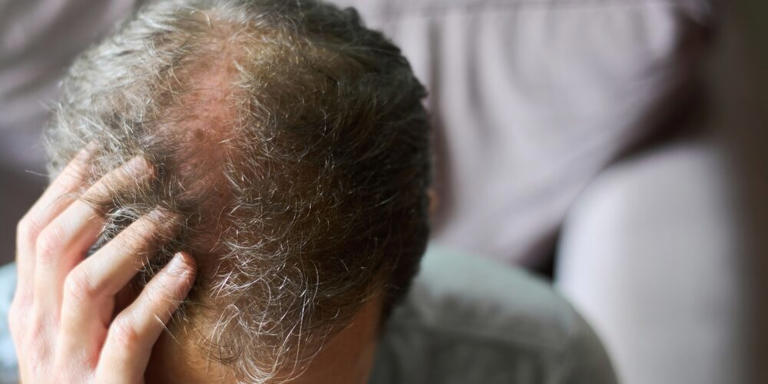 Men report erectile problems linked to hair loss drug
