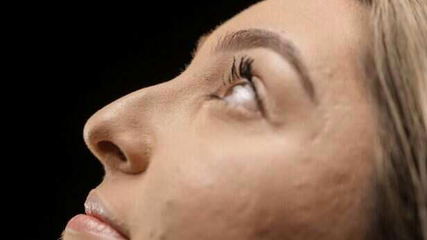 Would you still get rhinoplasty if you knew these pros and cons?