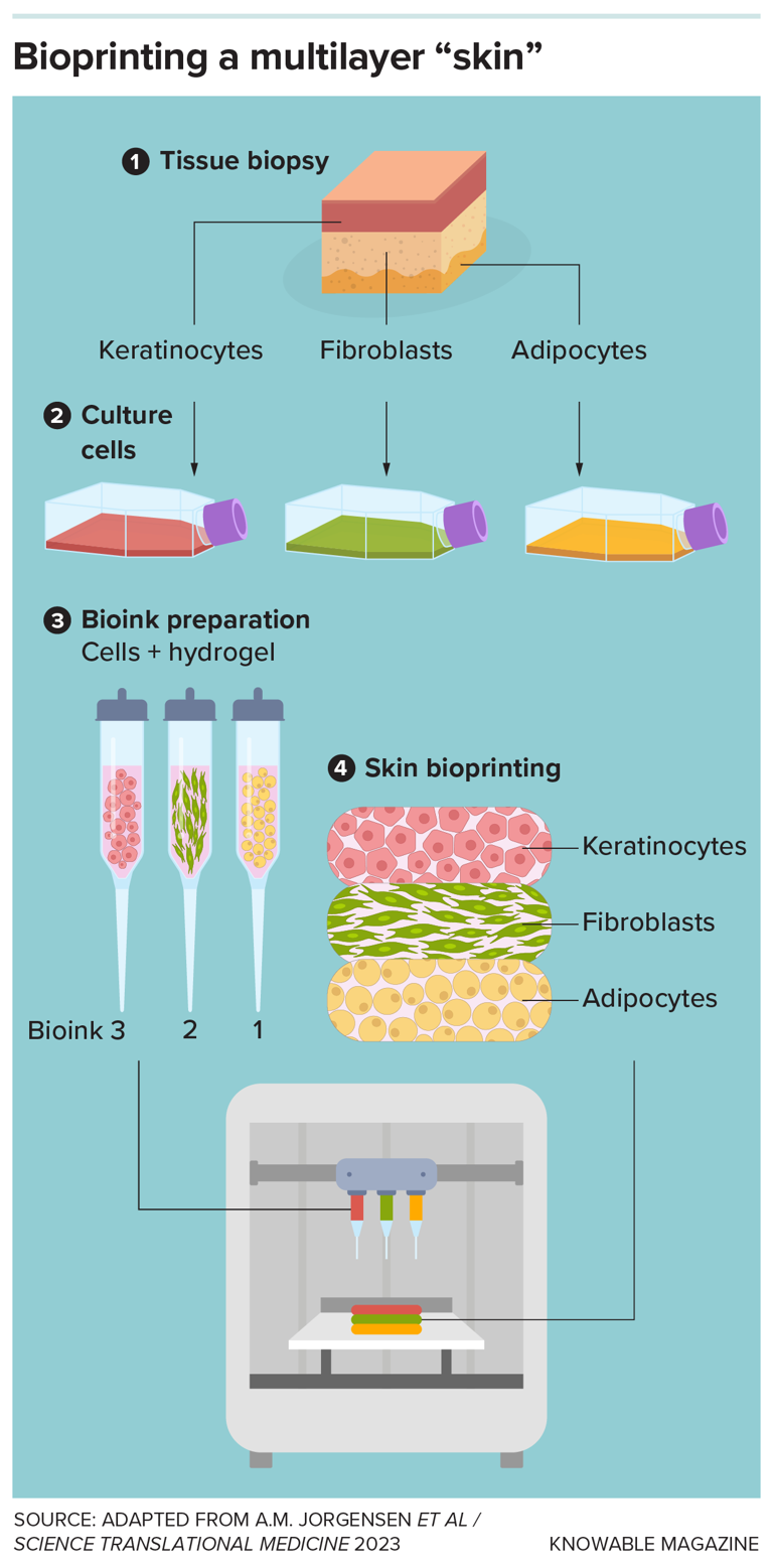 Can printed 'skin' heal burns and prevent scars?