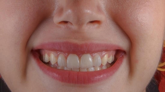 Charcoal, oil pulling, or purple toothpaste? Dentist reveals which ...