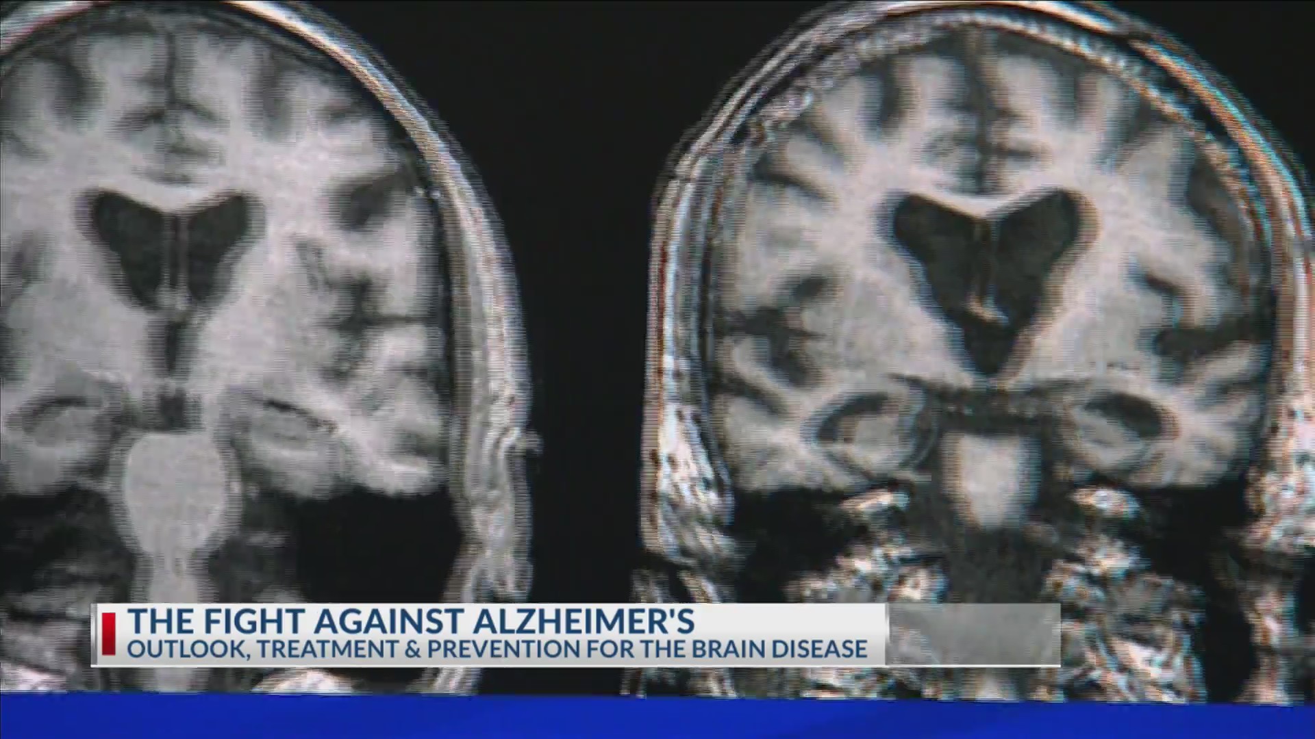 Alzheimer’s & the latest in radiology tech advancements | 17 News at ...