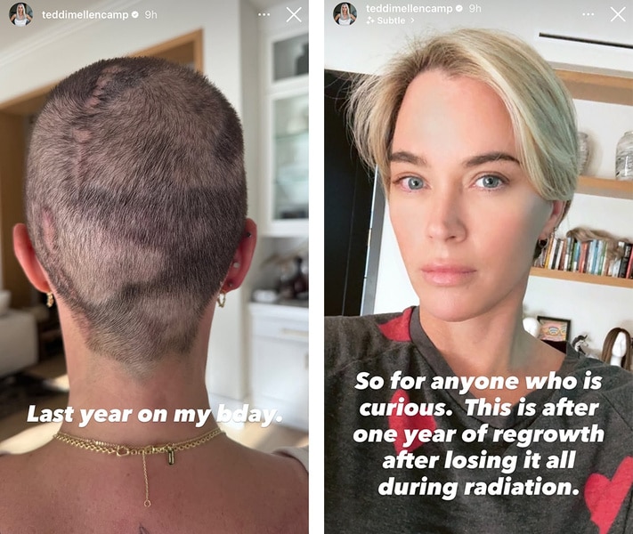 A split of Teddi Mellencamp showing off her hair during her cancer journey.