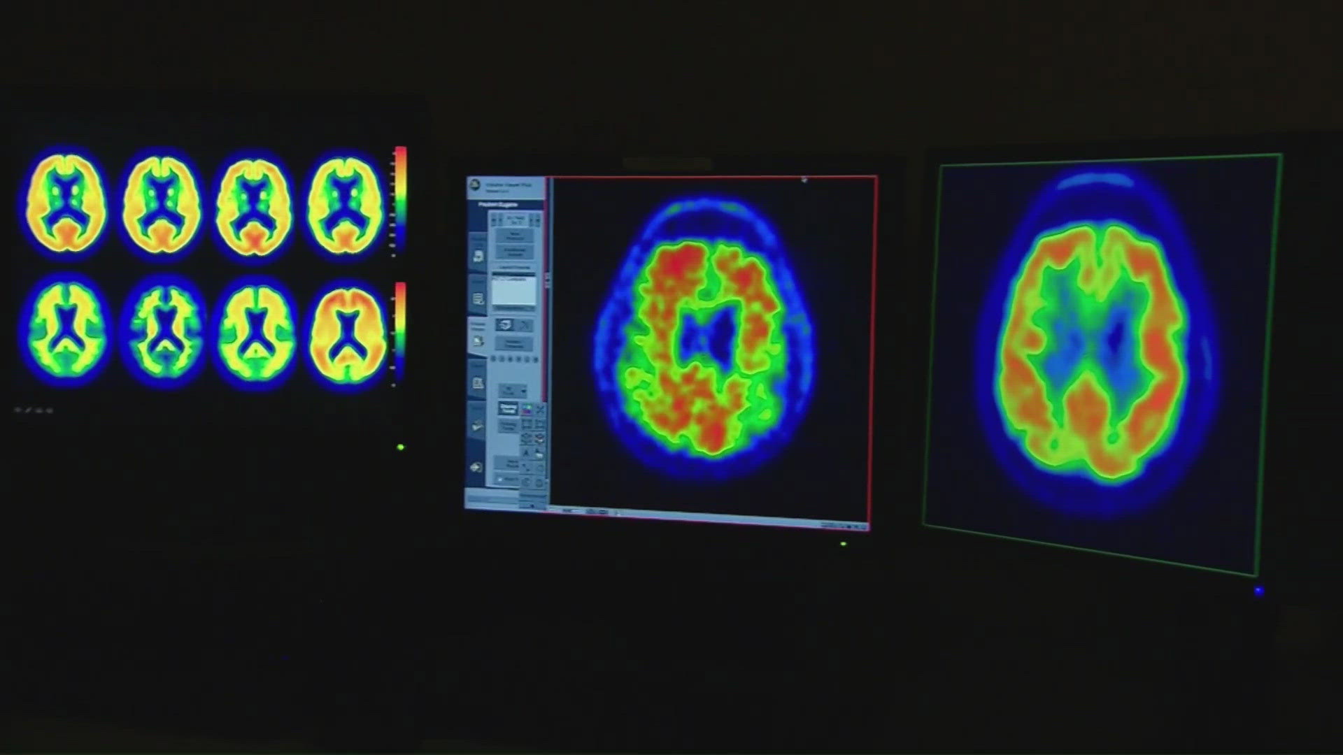 New work being done to help diagnose multiple sclerosis sooner