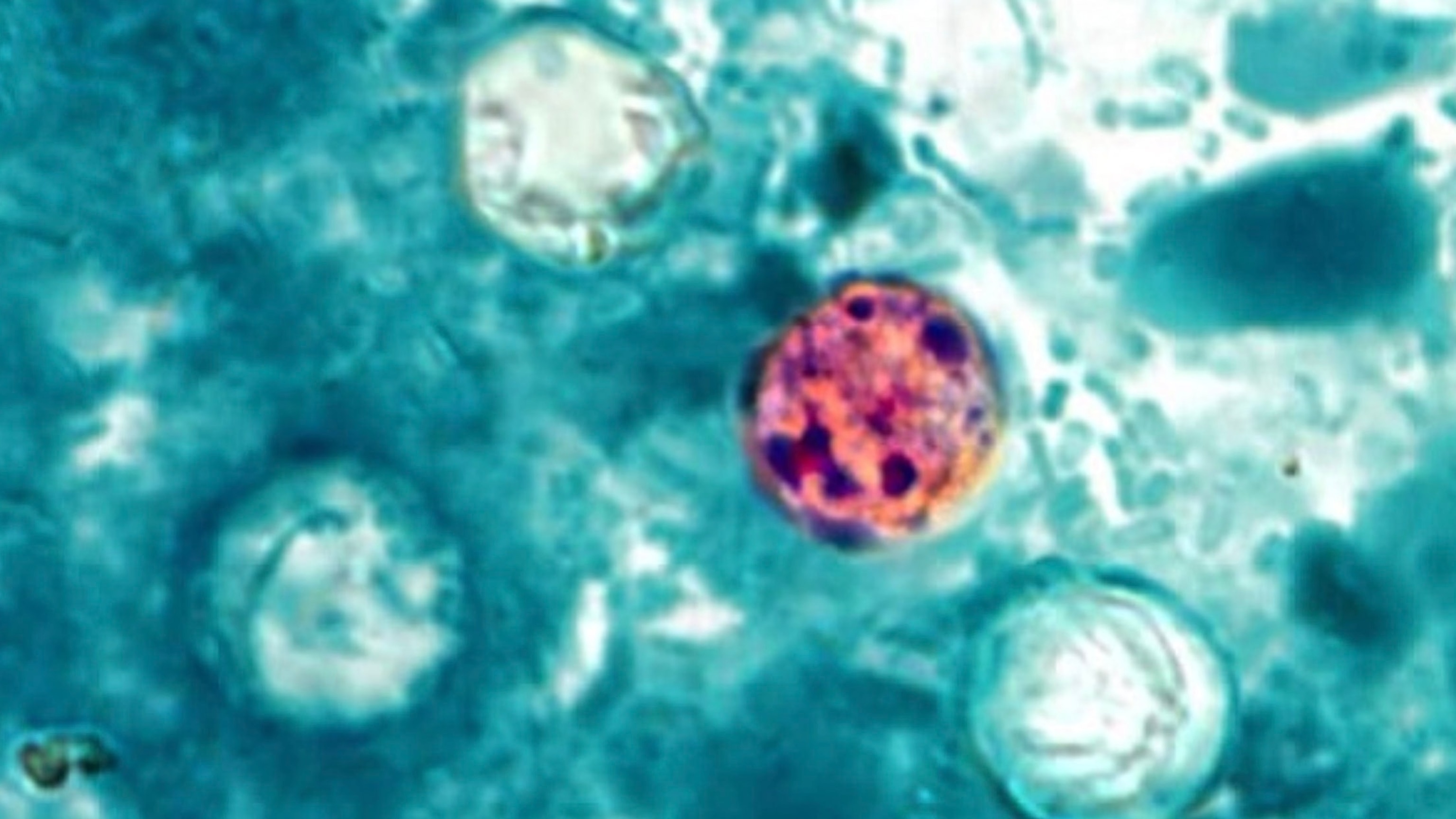 'Large and growing' parasitic infection outbreak spreading in Michigan