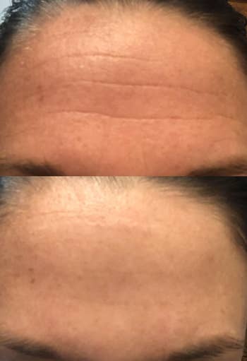 Two images show a forehead before and after using a skincare product