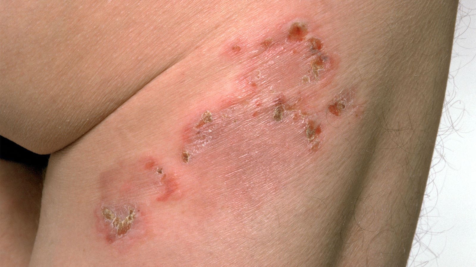 Newer diabetes drugs, including GLP-1 agonists, tied to autoimmunity risk