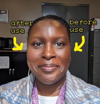 reviewer smiling, showing clear skin comparison labeled