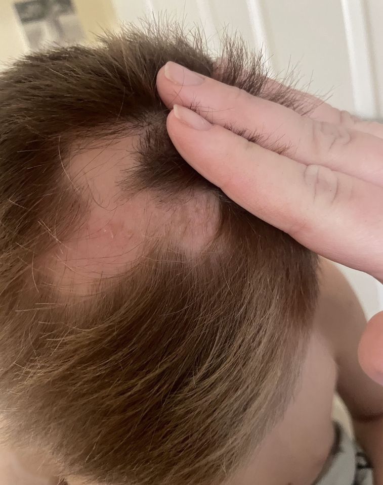 LEO OSBORNE, NOW 10, LOSING HIS HAIR AFTER BEING DIAGNOSED WITH ALOPECIA