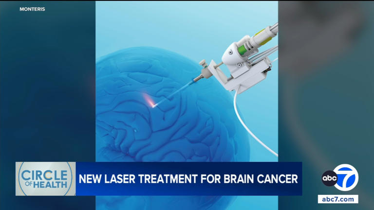 Laser treatment helps brain cancer patient surpass 7-year survival ...