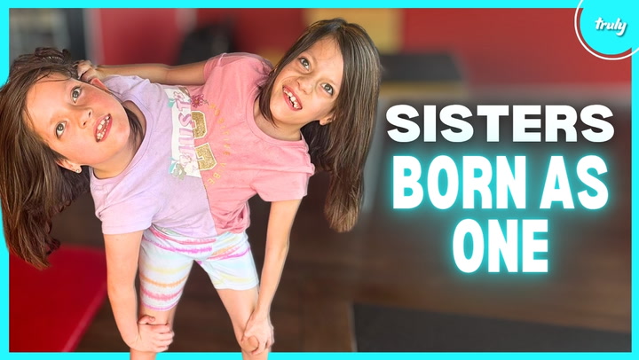 Our Conjoined Twins Refuse To Be Separated Born Different 