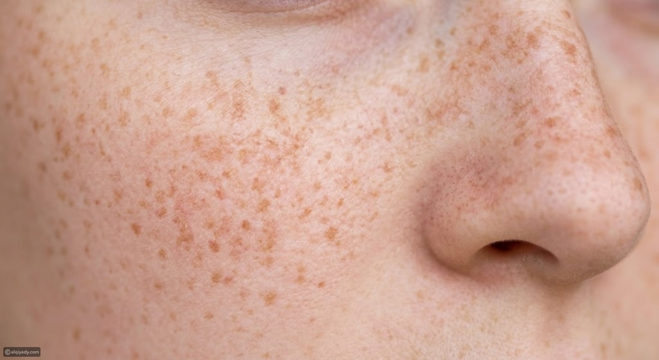 melanotan causing freckles Dangerous' tanning products promoted by influencers Freckles | Tirath Ram Shah