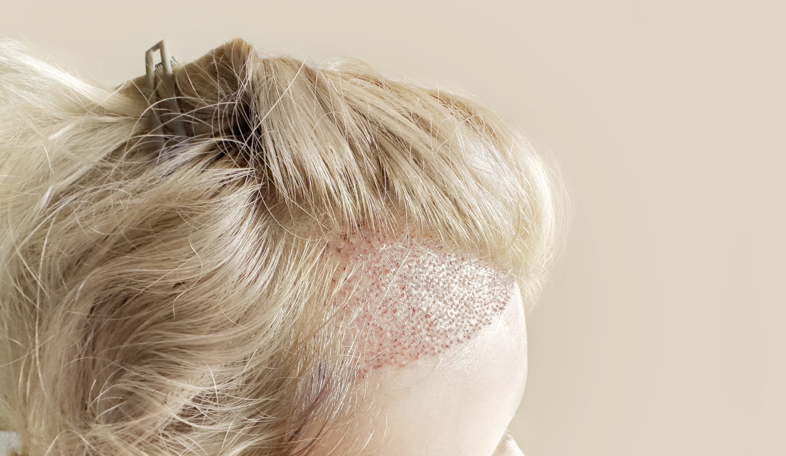 Scientists discover how natural hair patterns form without a blueprint