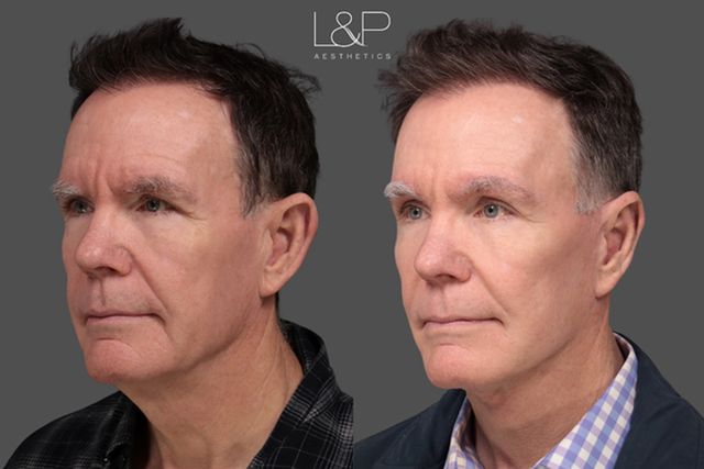 Charles before his facelift, Charles after his facelift