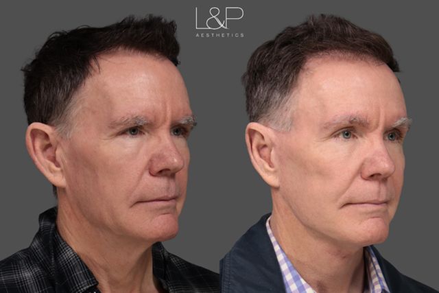 Charles before his facelift, Charles after his facelift