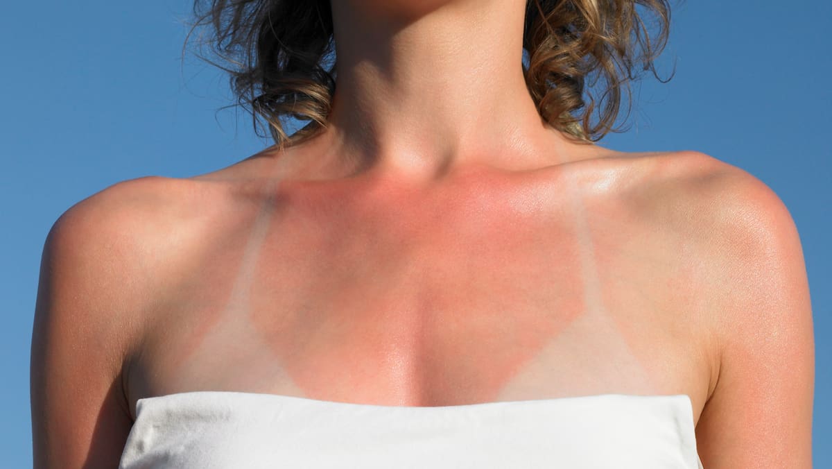 Sonnenbrand lindern: 6 bewährte Hausmittel bei Hautrötungen