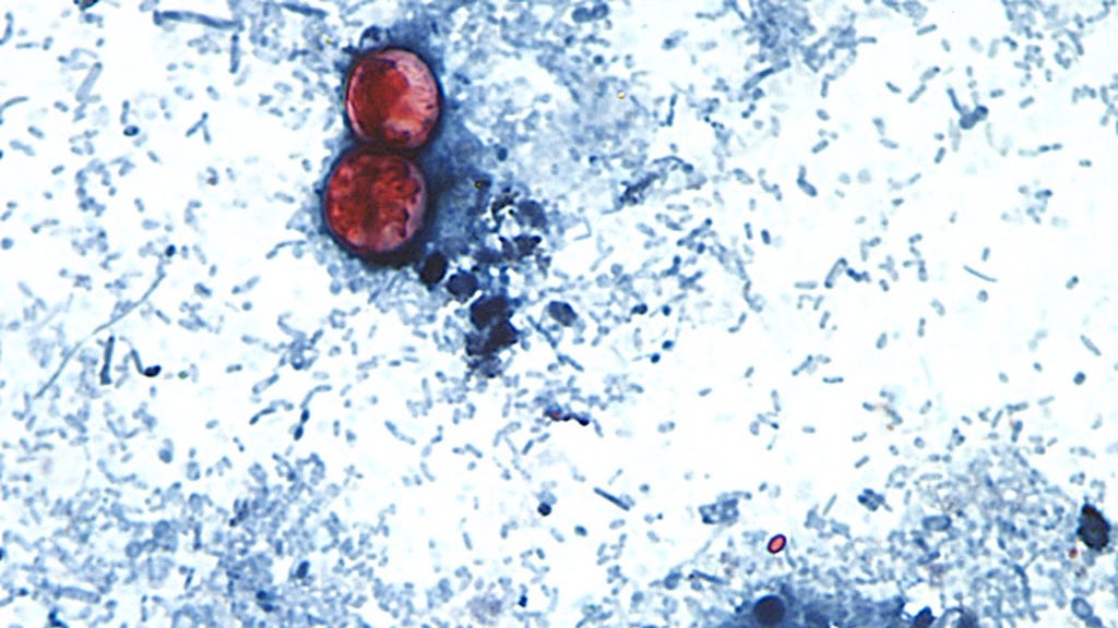 Cyclosporiasis in Iowa: What to know about the national outbreak