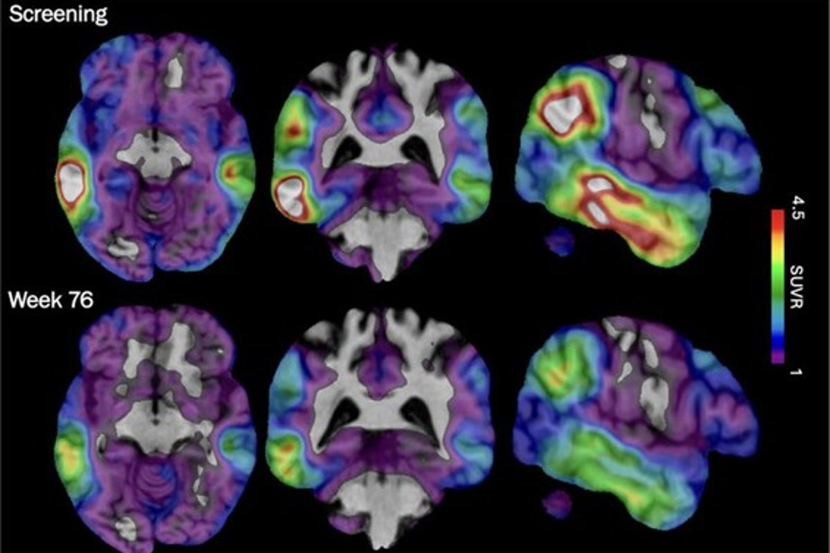 New experimental drug shows promise in slowing early Alzheimer’s