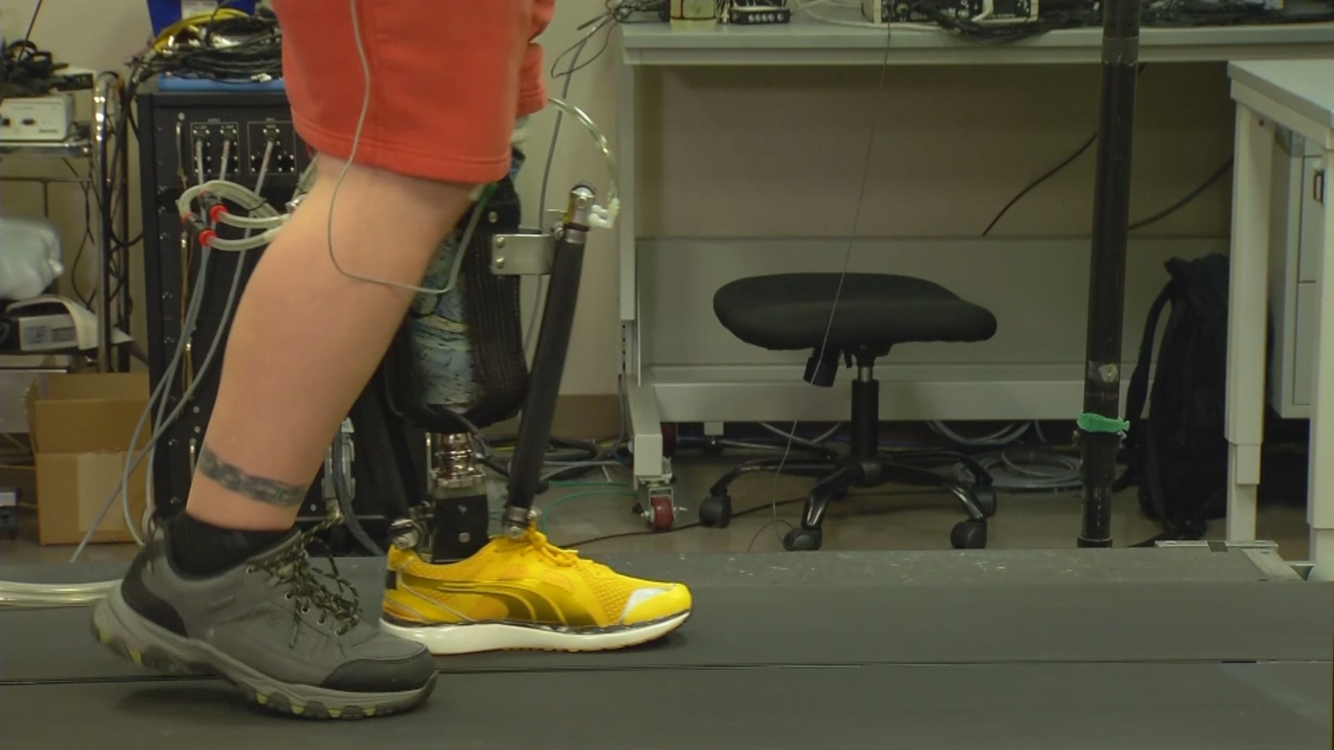 Robotic prosthetics offer hope for a pain-free future for amputees