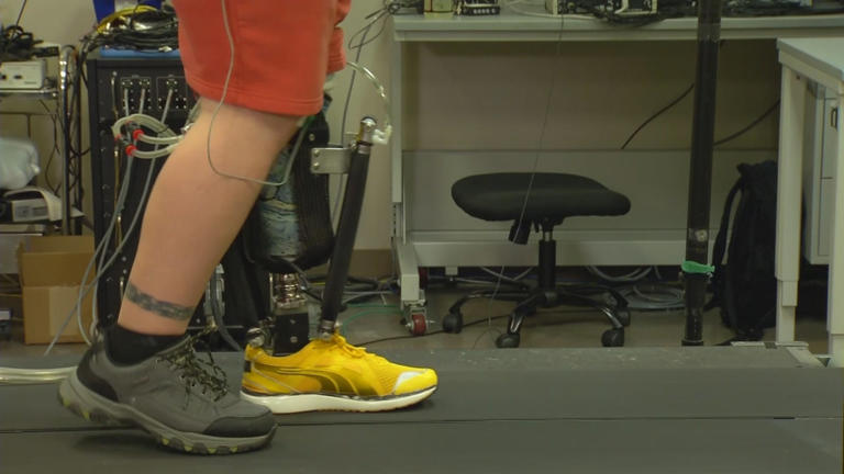 Robotic prosthetics offer hope for a pain-free future for amputees