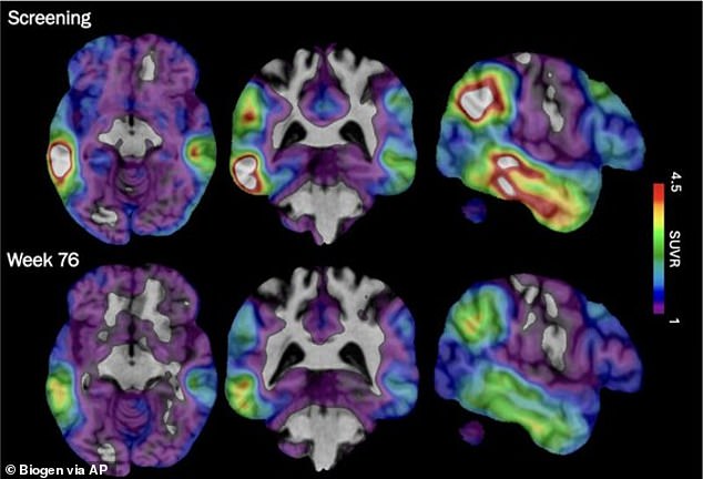 Alzheimer's Disease is the most common form of dementia