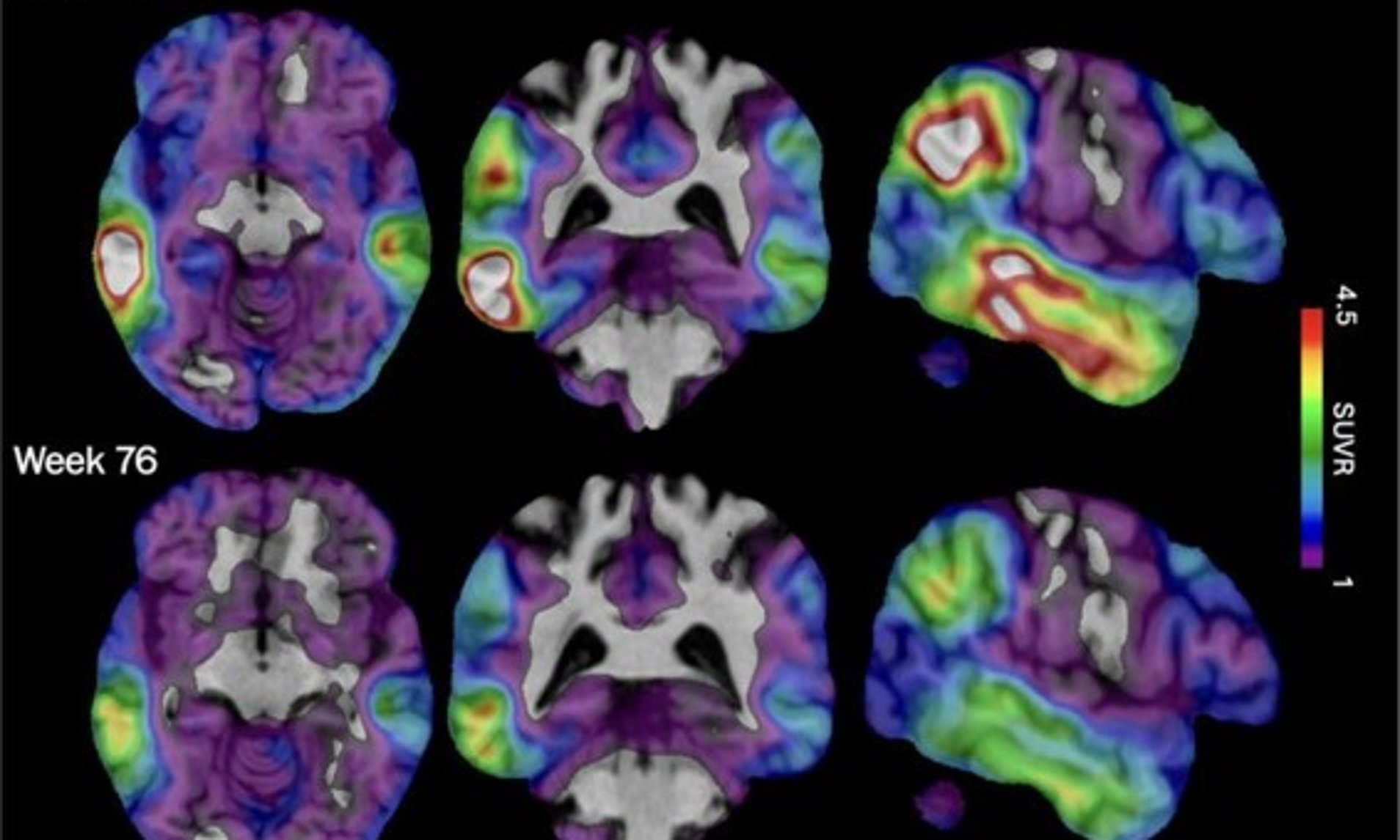 Blood test for Alzheimer's offered to UK patients - it can predict disease years before symptoms hit