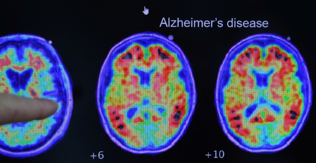 Blood test may detect Alzheimer’s risk in healthy people, study finds