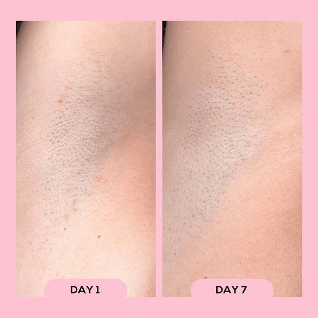 Side-by-side comparison of underarm skin labeled
