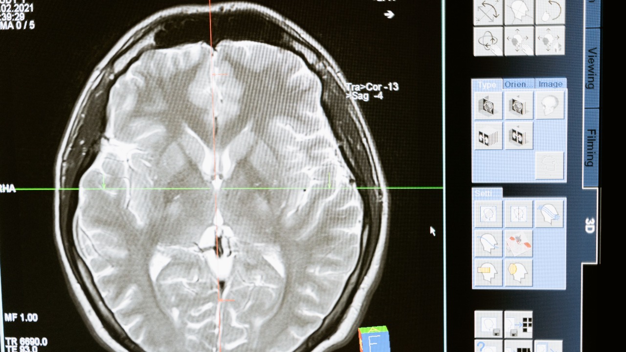 Microplastics turned up in 100% of the human brains scientists tested