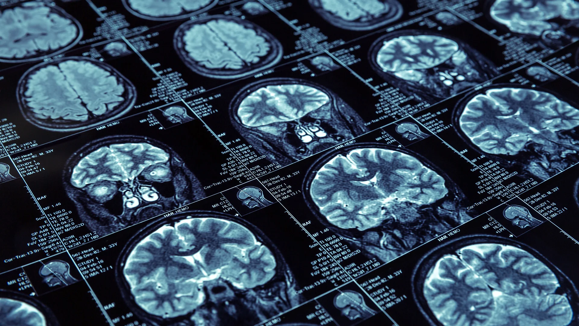 Stopping Cognitive Decline? Scientists Just Discovered the Protein Driving the Spread of Alzheimer’s
