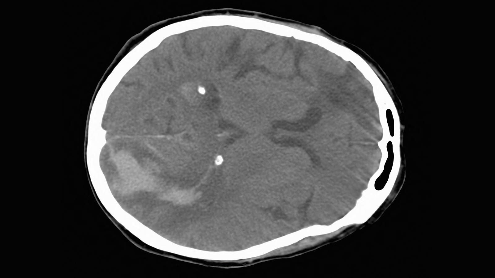 Aspects fails to reflect ceiling for endovascular stroke therapy benefit