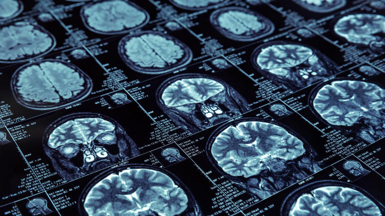What is CTE, chronic traumatic encephalopathy?