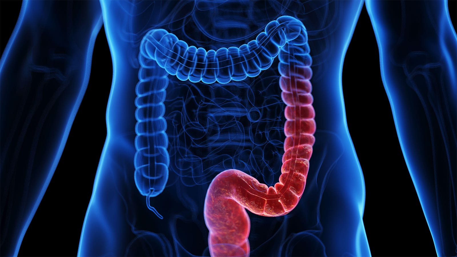 JAK and IL-23 inhibitors for ulcerative colitis: Making decisions about dosage