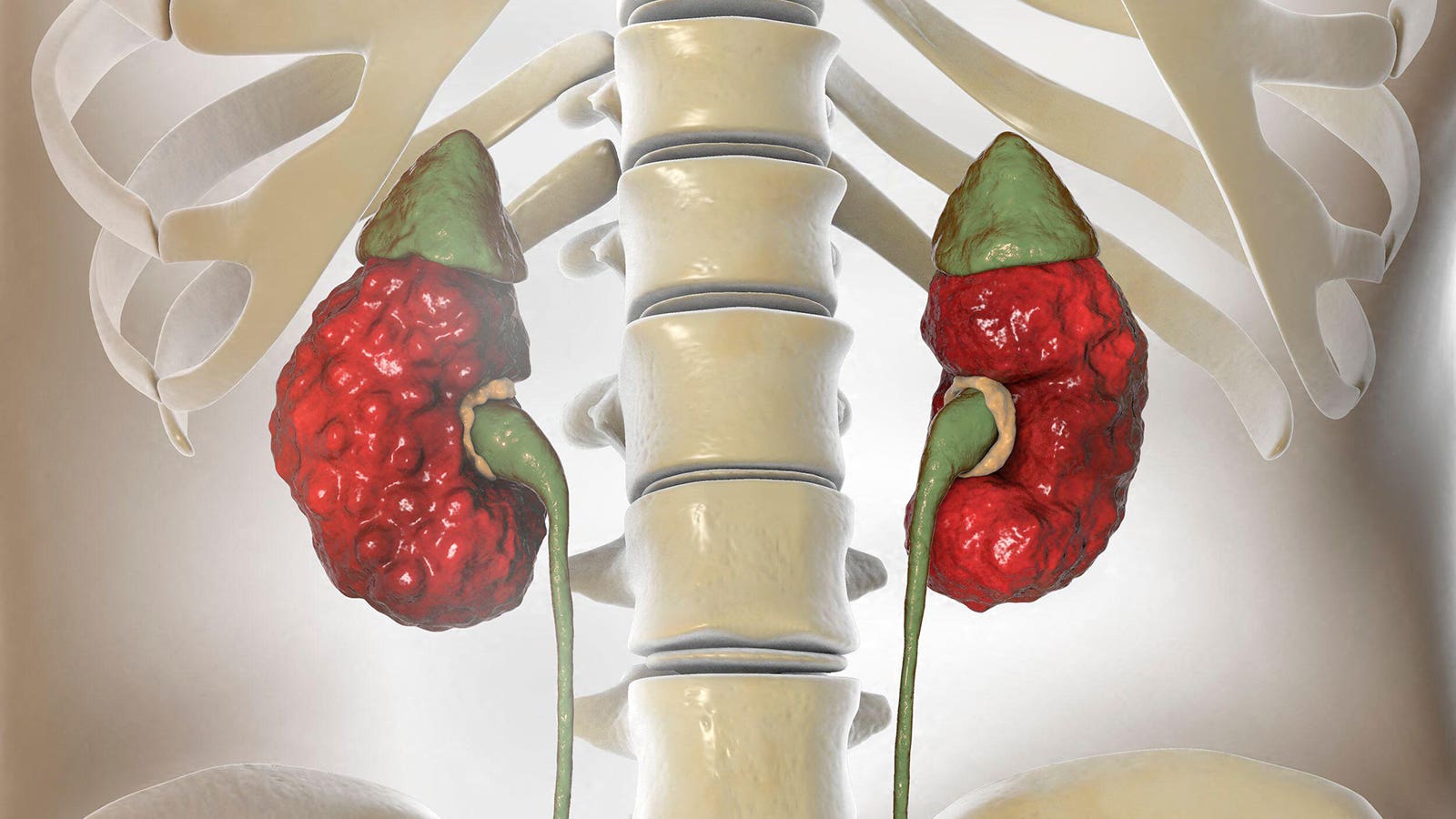 Chronic kidney disease increasingly driven by diabetes