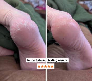 Close-up of a foot before and after treatment showing improved skin condition. Text: