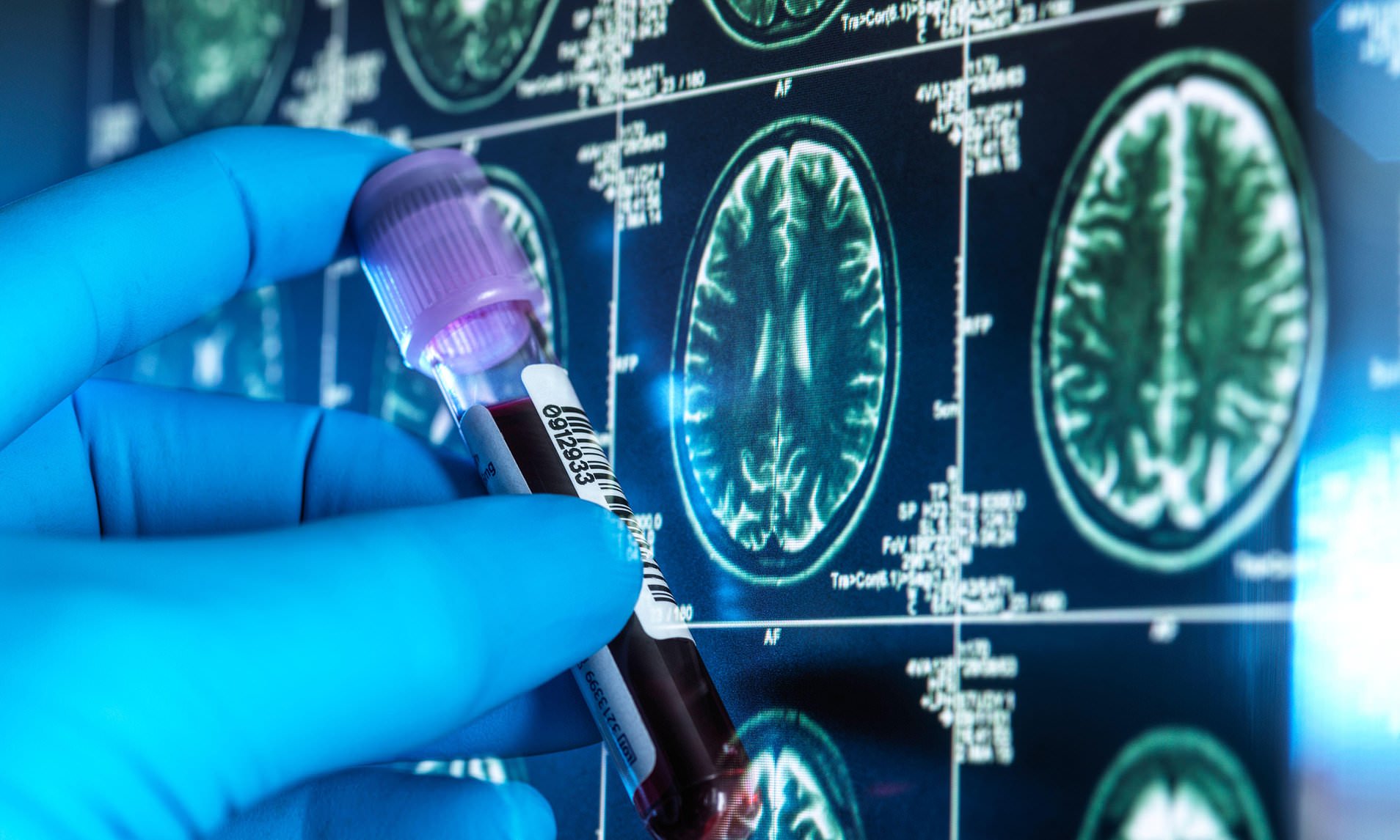 Alzheimer's 'wonder drug' could delay disease for three years, striking new evidence shows