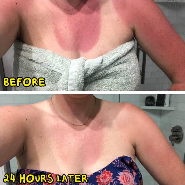 Before and after of sunburn on shoulders and chest. Top image shows redness; bottom image shows reduced redness. Person wearing towel and patterned top