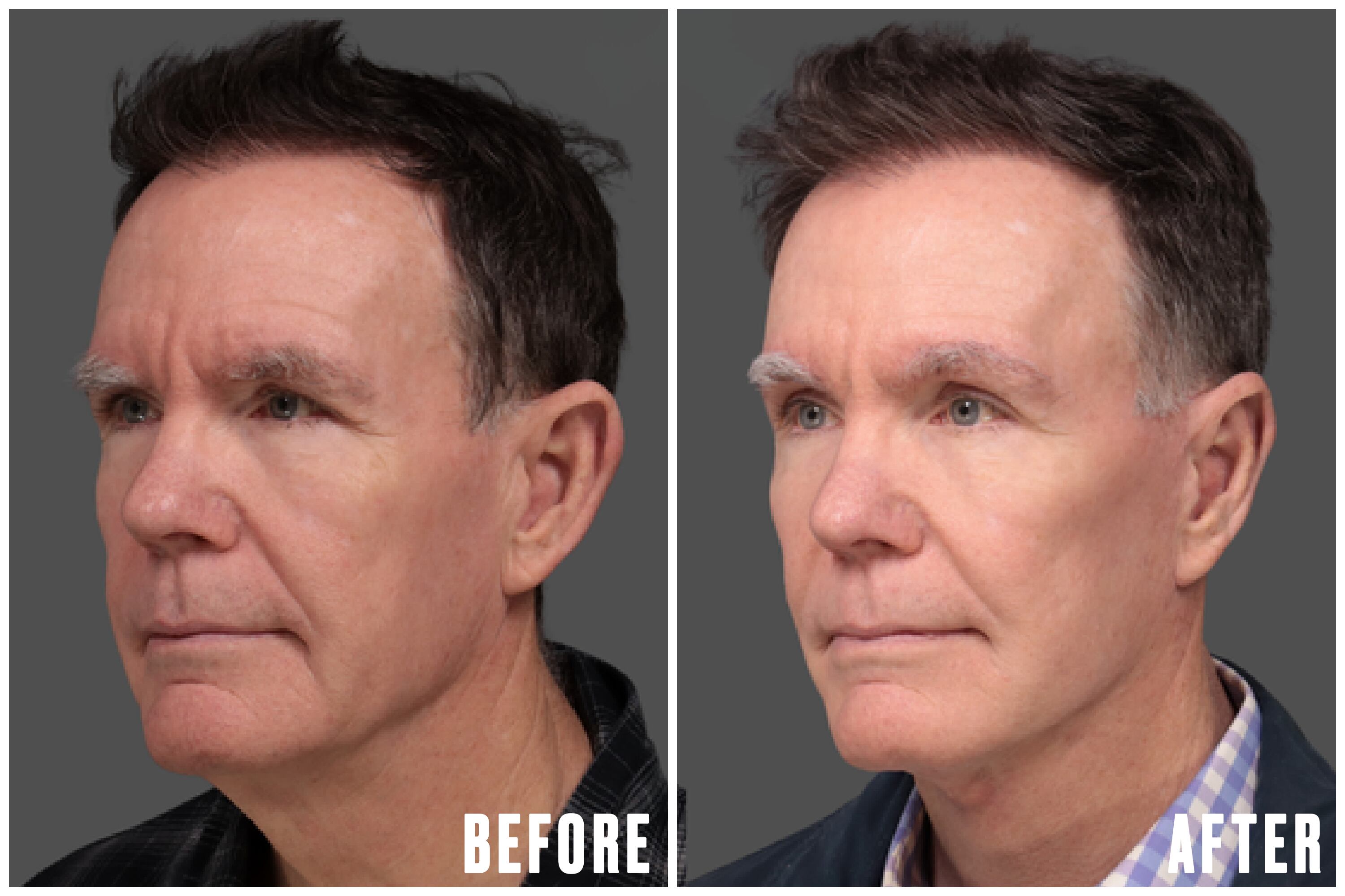 Charles thought that his reflection in the mirror looked angry before he underwent plastic surgery. / The Daily Beast/L&P Aesthetics