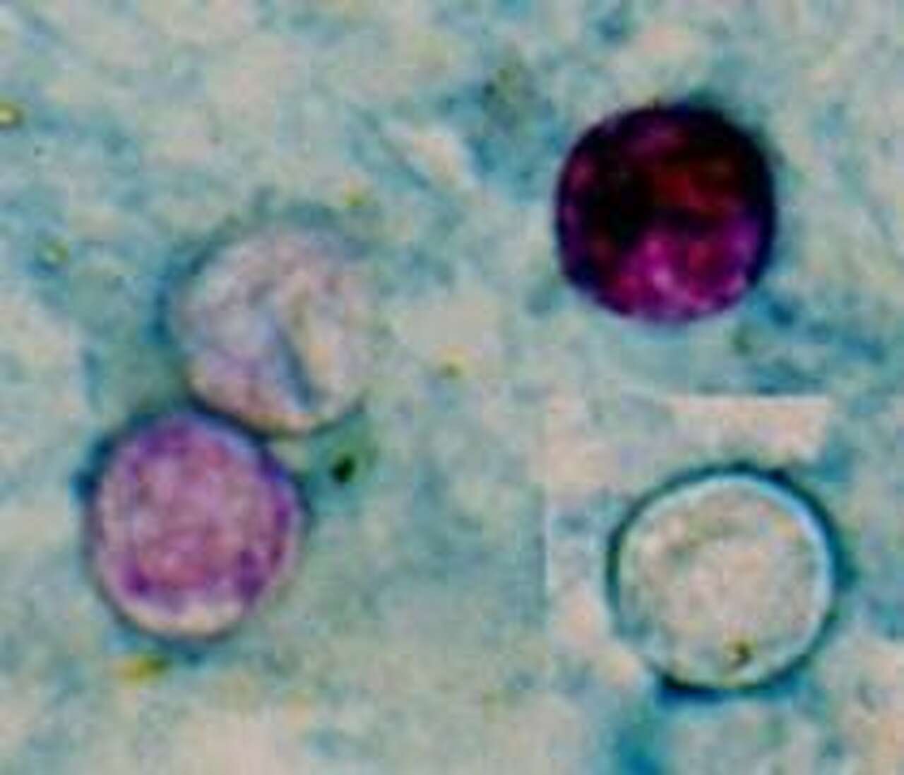‘Explosive' diarrhea parasite and stomach bugs define Austin's summer illnesses