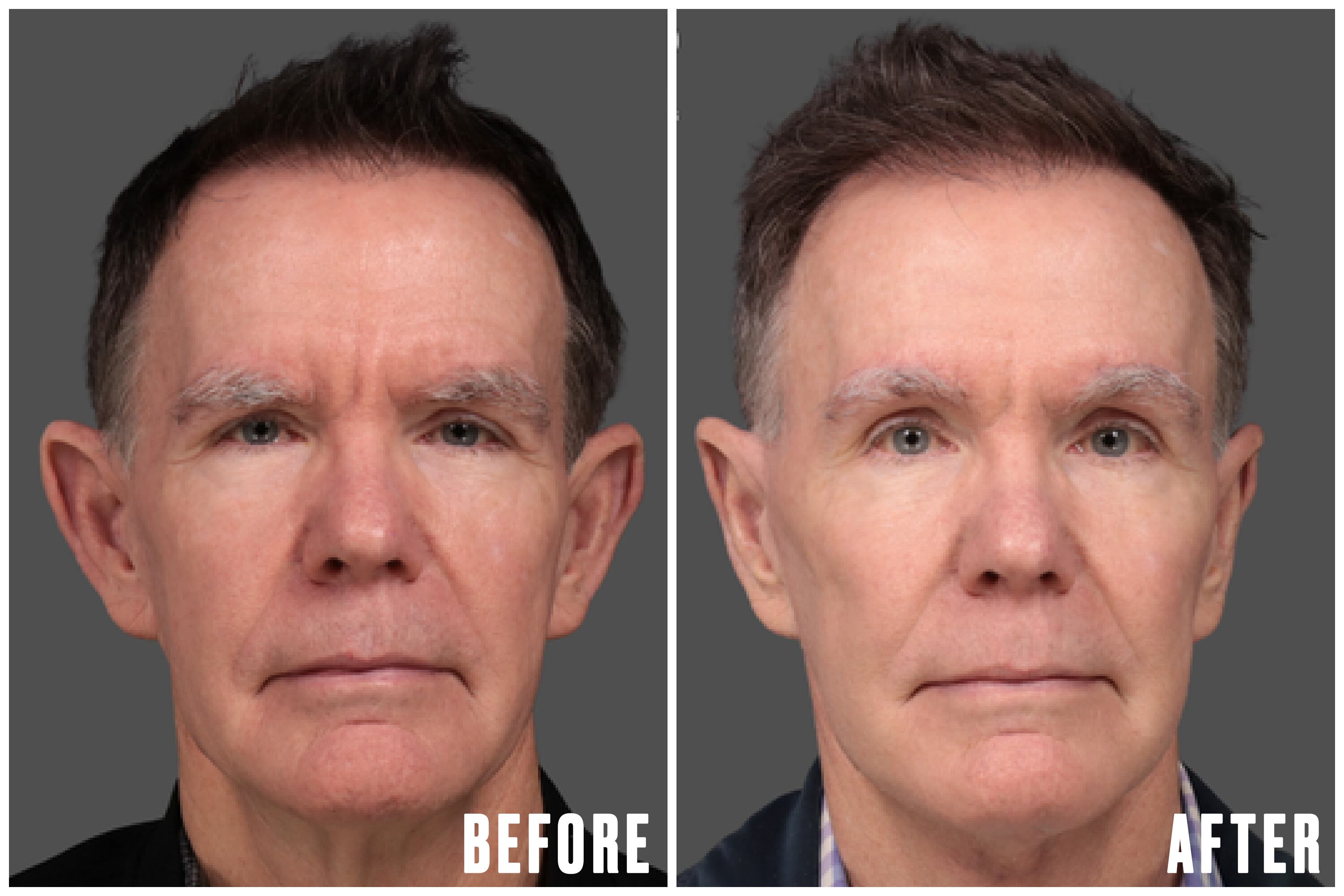 In addition to his facelift, neck lift, and brow lift, Charles opted to subtly alter his ears with otoplasty. / The Daily Beast/L&P Aesthetics