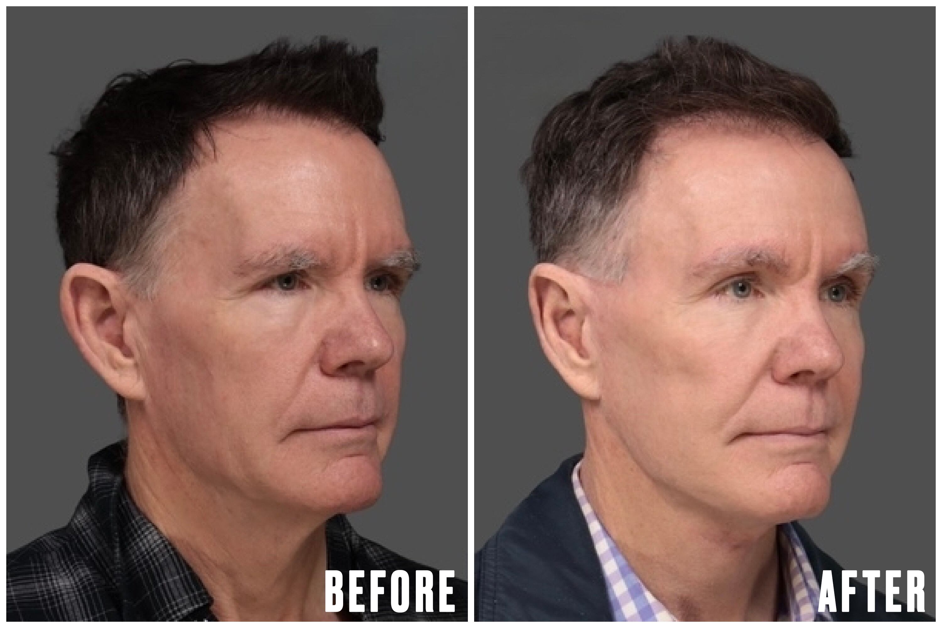 Charles's transformation was subtle enough that others did not realize that he had undergone plastic surgery, but dramatic enough for people to notice and compliment his refreshed appearance. / The Daily Beast/L&P Aesthetics