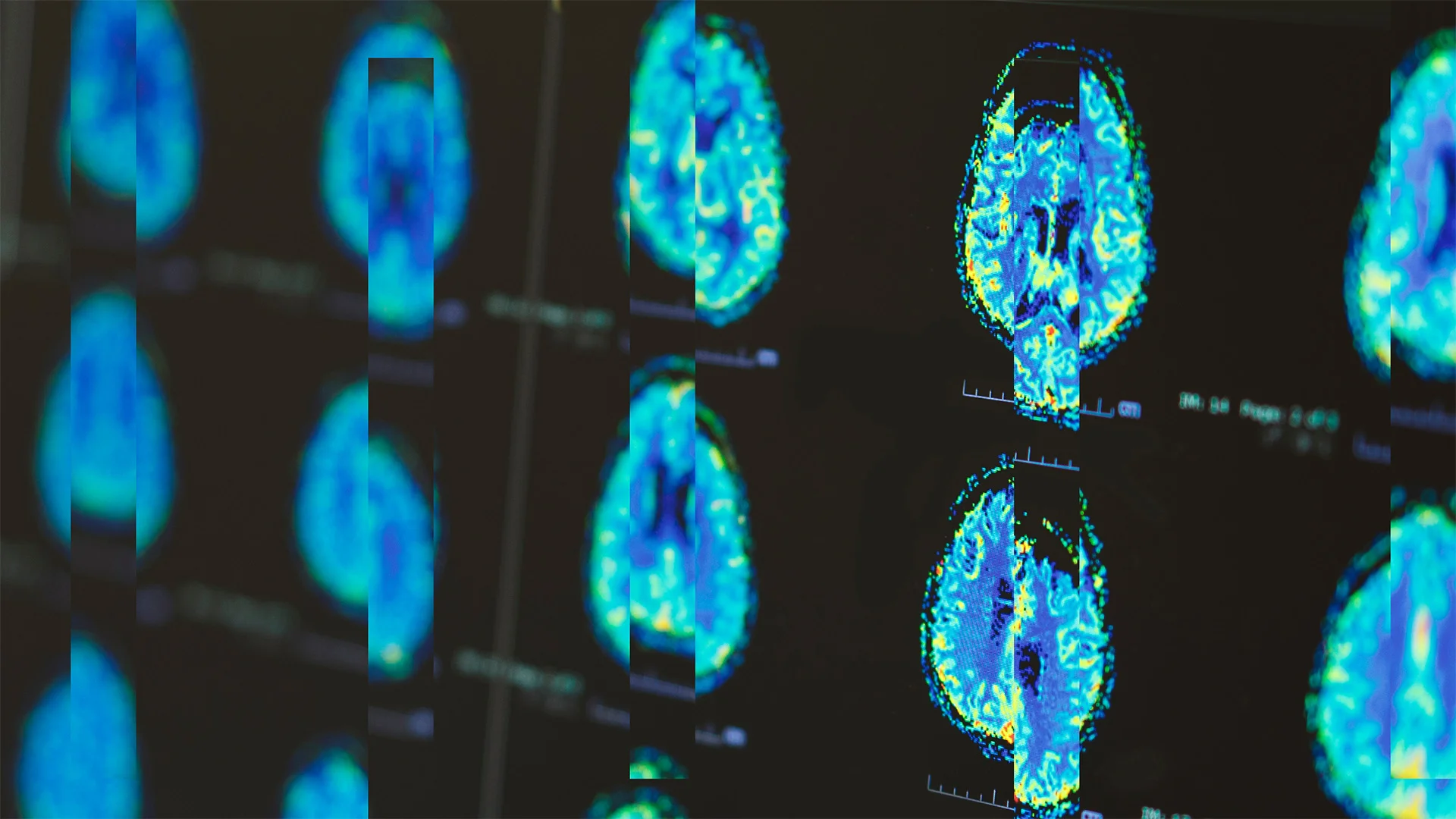 What ADHD does to your body could be just as important as what it does to your brain