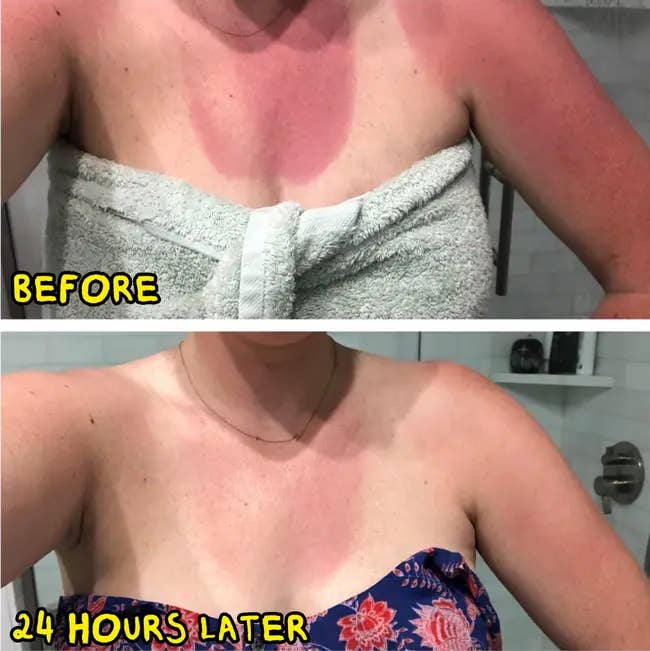 Two images show a woman's sunburn before and 24 hours after using a remedy, with visibly reduced redness in the second image
