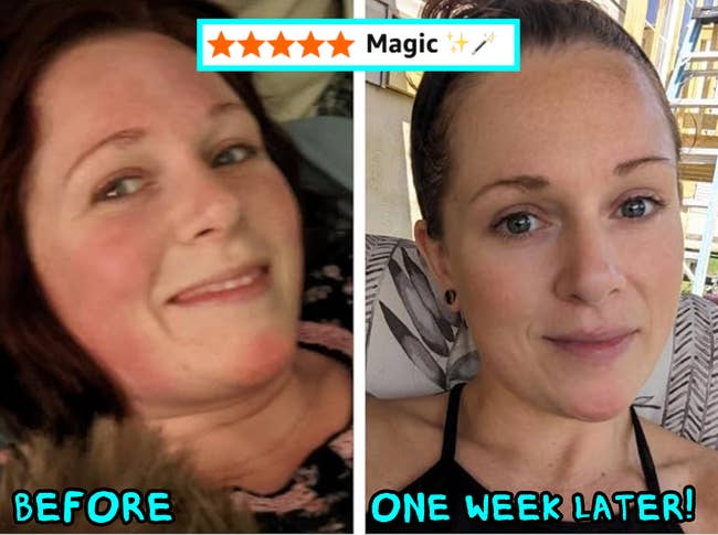 Two side-by-side images of a person, labeled before and one week later, showing a skincare product's effectiveness with smoother skin