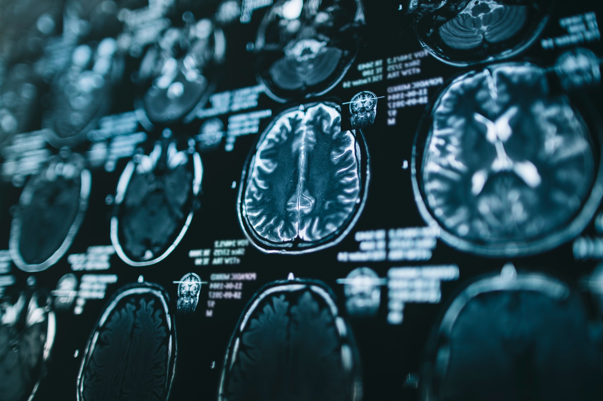 Magnetic resonance scan of the brain