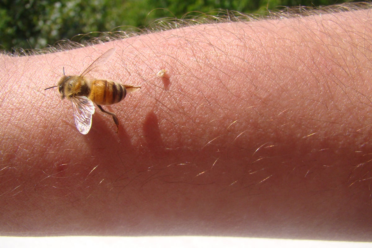 woman-turns-to-bee-venom-therapy-to-treat-lyme-disease-symptoms